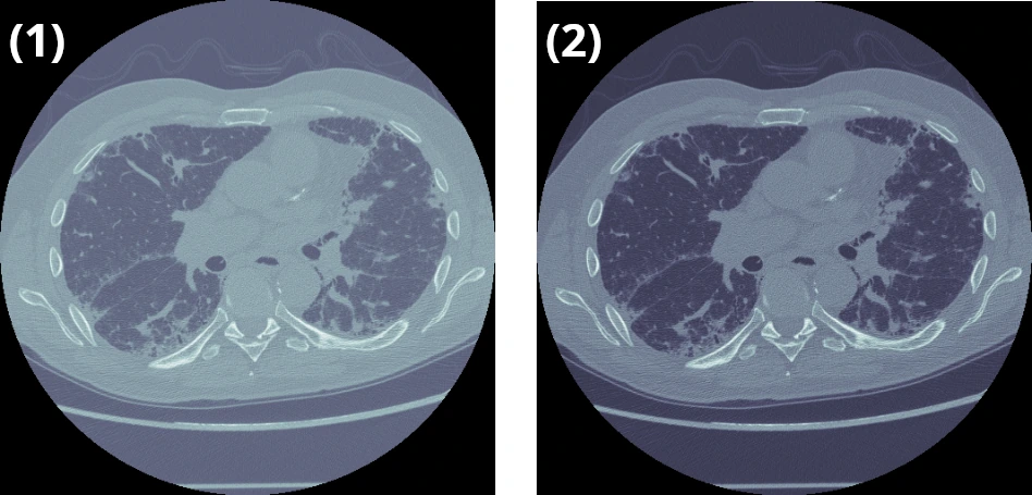 Standardisation HU : (1) Coupe DICOM brute, (2) Seuillage Hounsfield