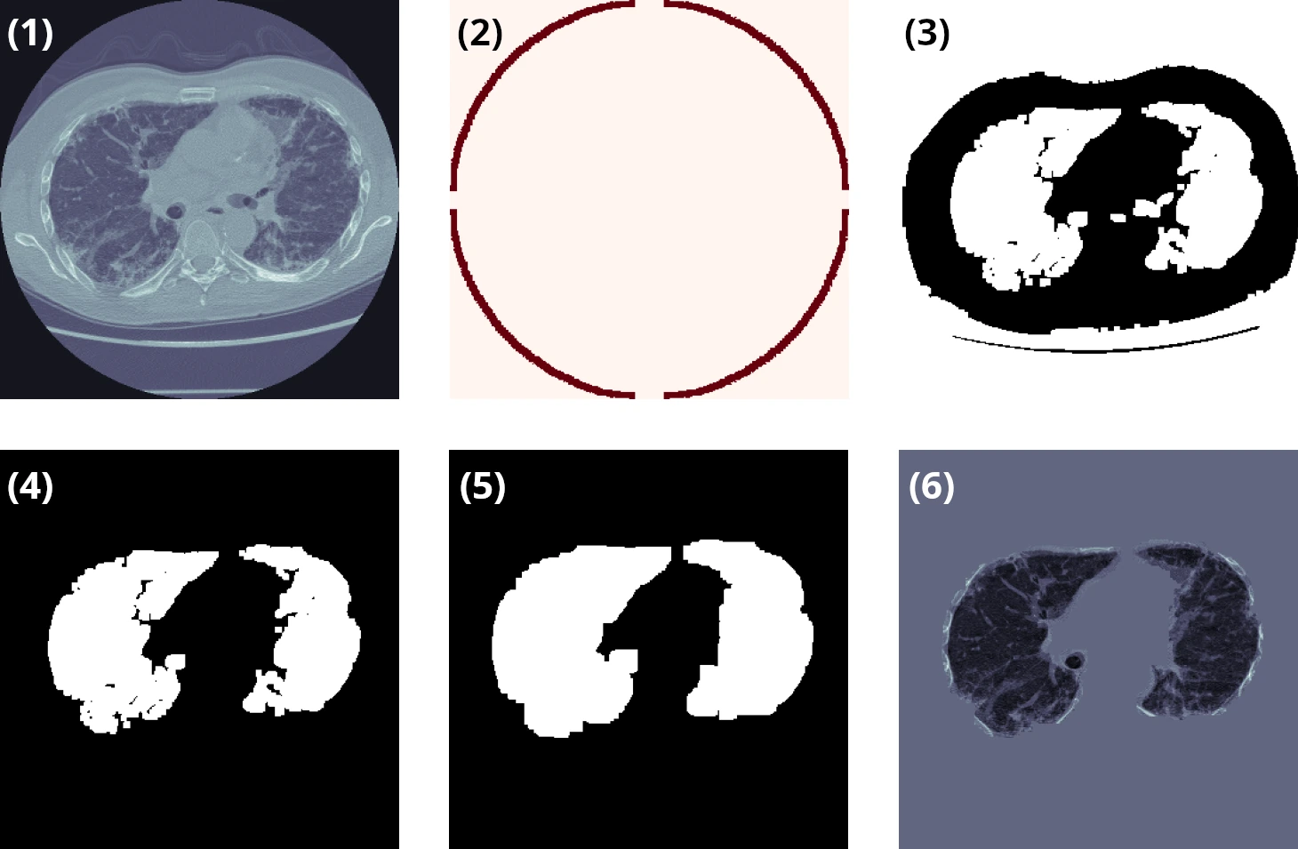 Étapes de la segmentation pulmonaire 3D