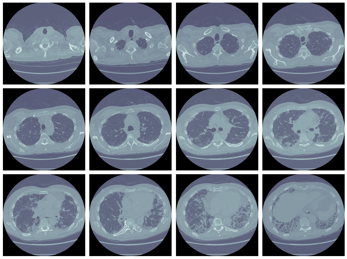 Coupes axiales CT volumétriques (patient OSIC)