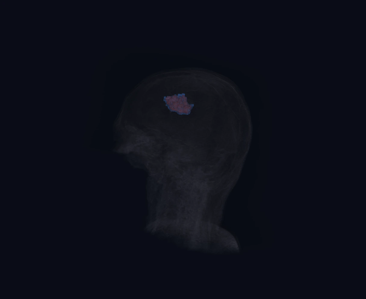 3D Surface Rendering and Volumetric Overlay of Brain Tumor
